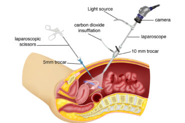 How-is-laparoscopic-surgery-done